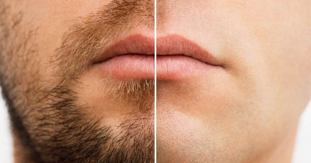 Laser Barba x 5 sesiones
