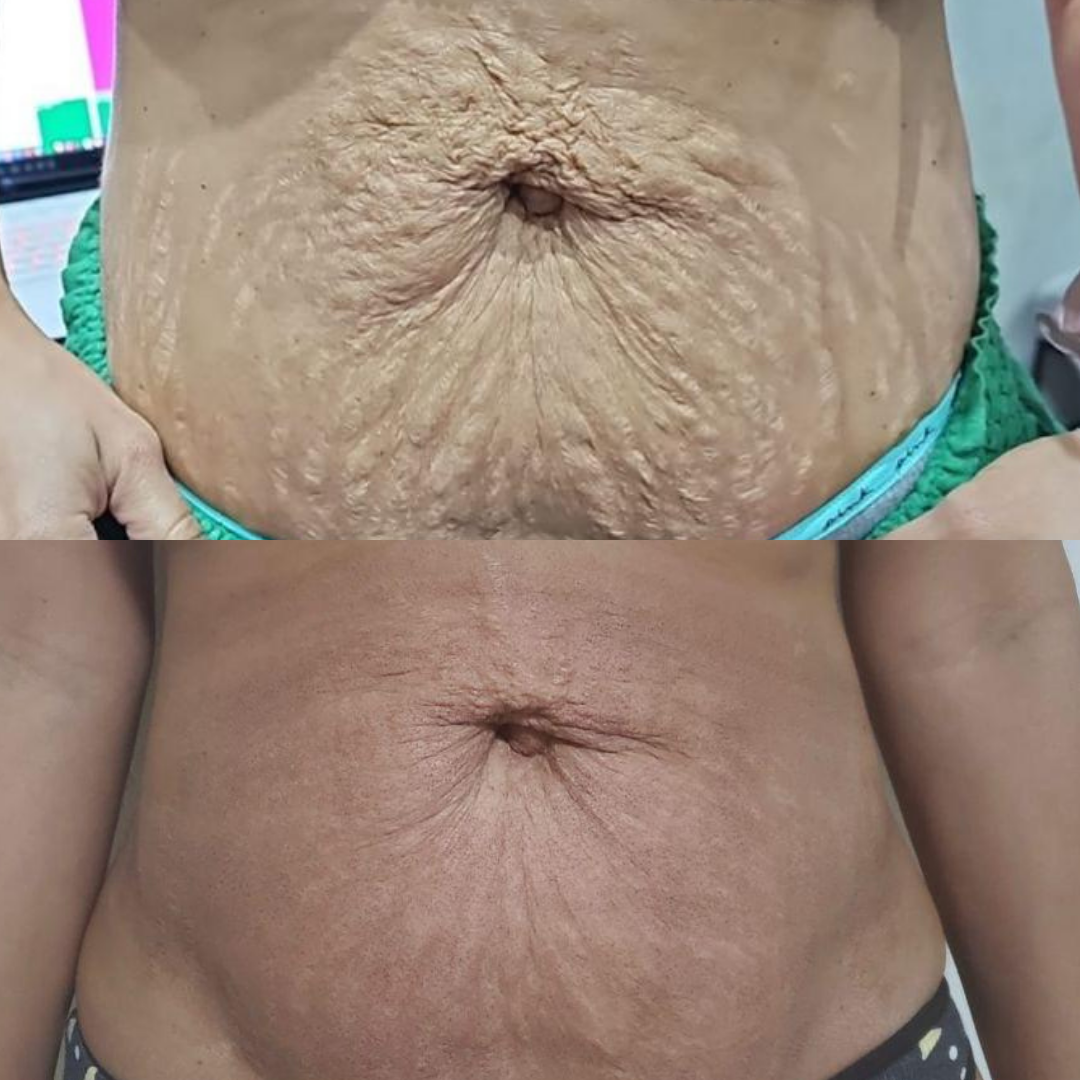 6 Venus Legacy Abdomen + 3 Moxi Abdomen + 6 SkinTyte Abdomen