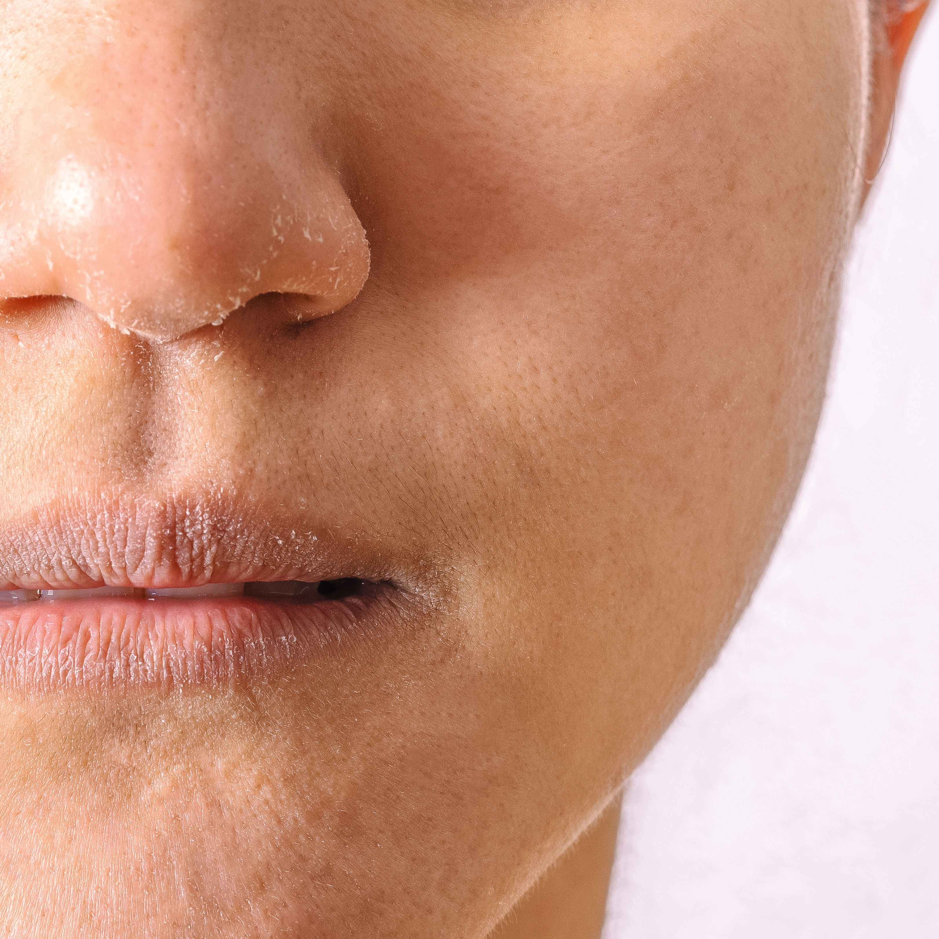 Dry Skin