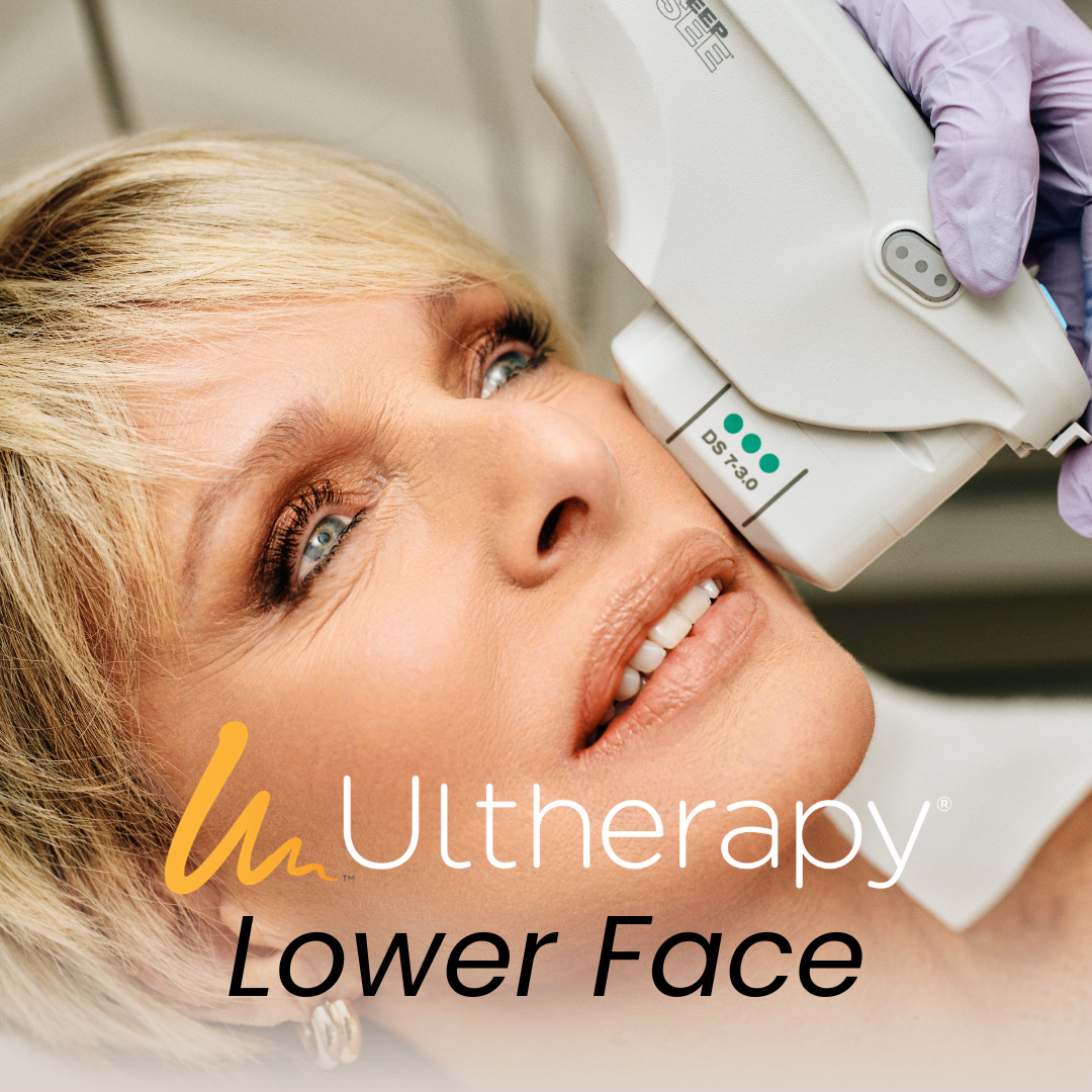 PRIME: 1 Ultherapy Lower Face