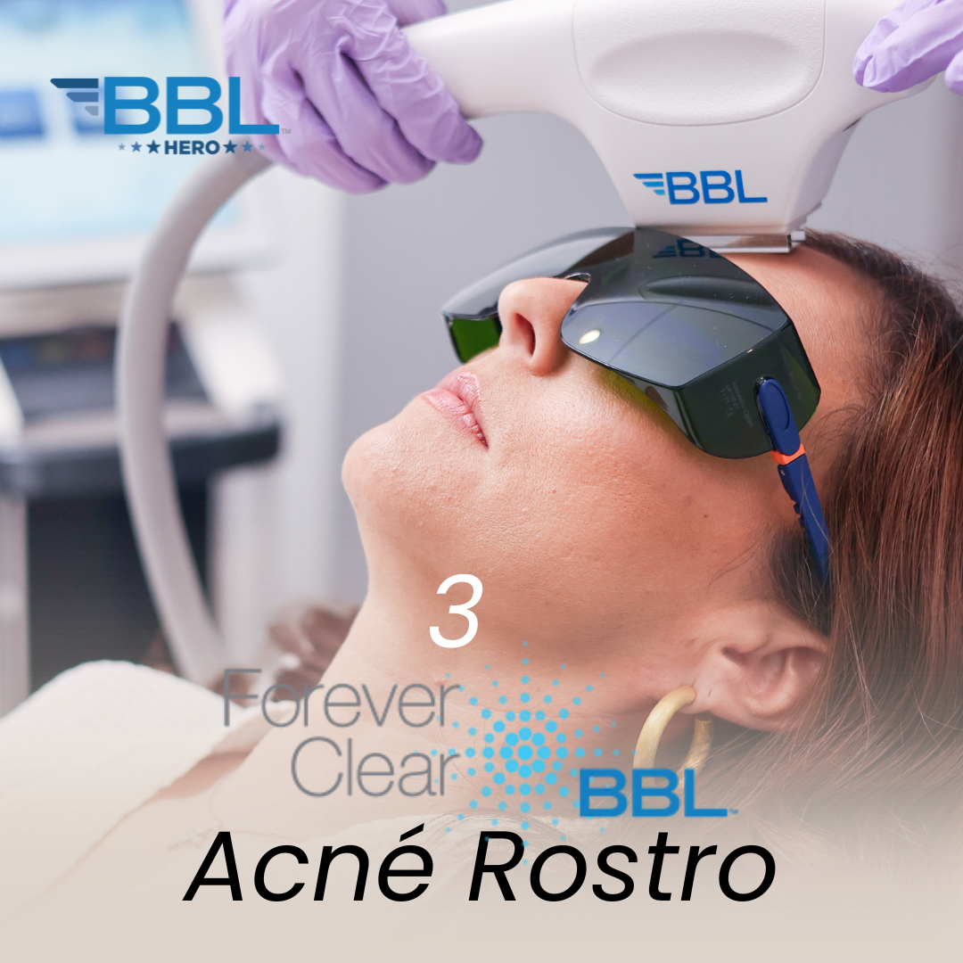 PRIME: 3 BBL Acne Rostro (Forever Clear BBL)