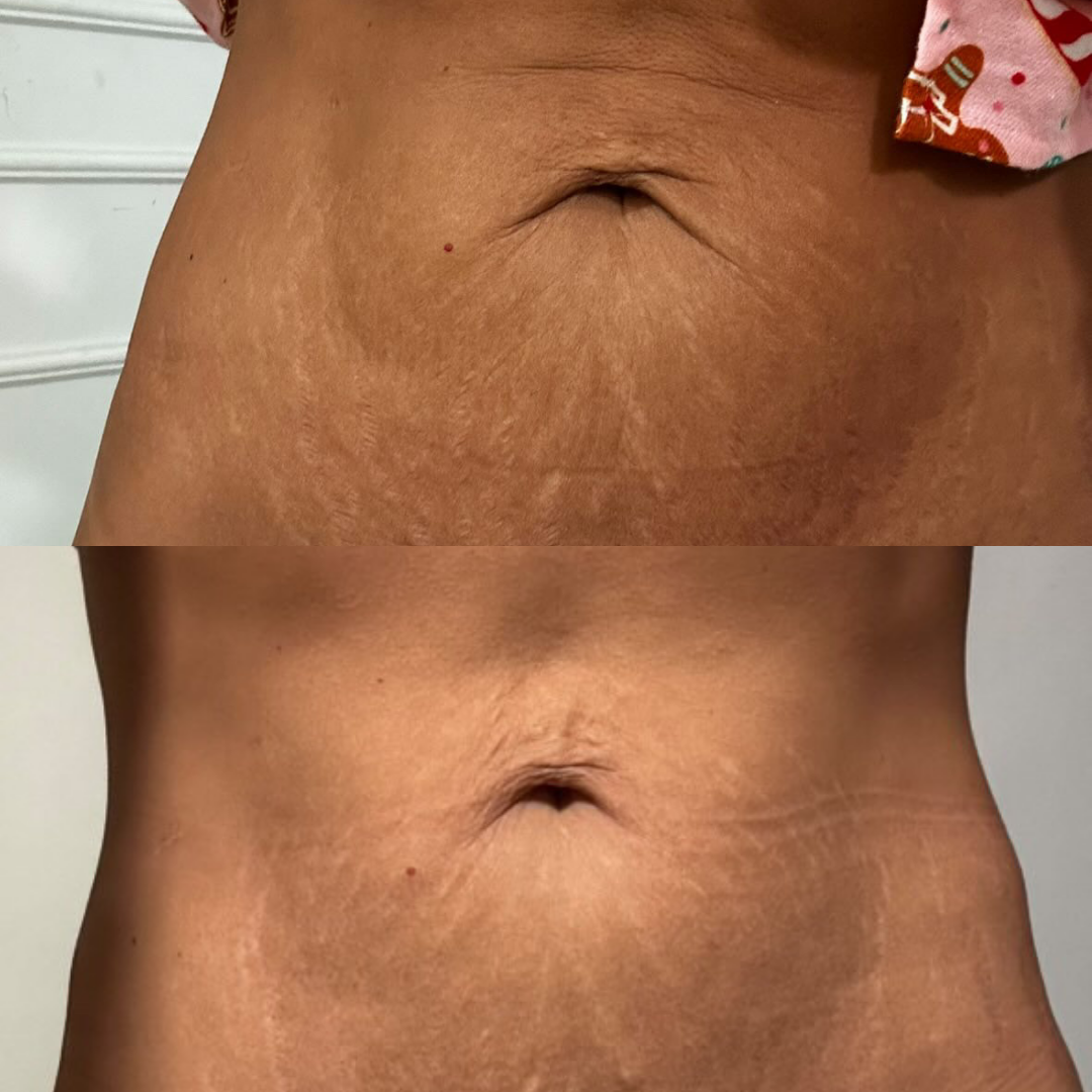 Skintyte Abdomen x 6