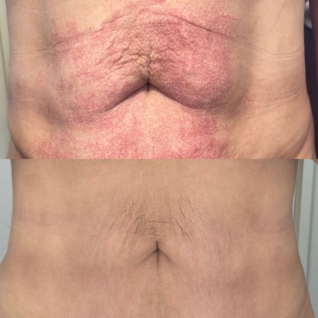 Moxi Resurface Abdomen x 3
