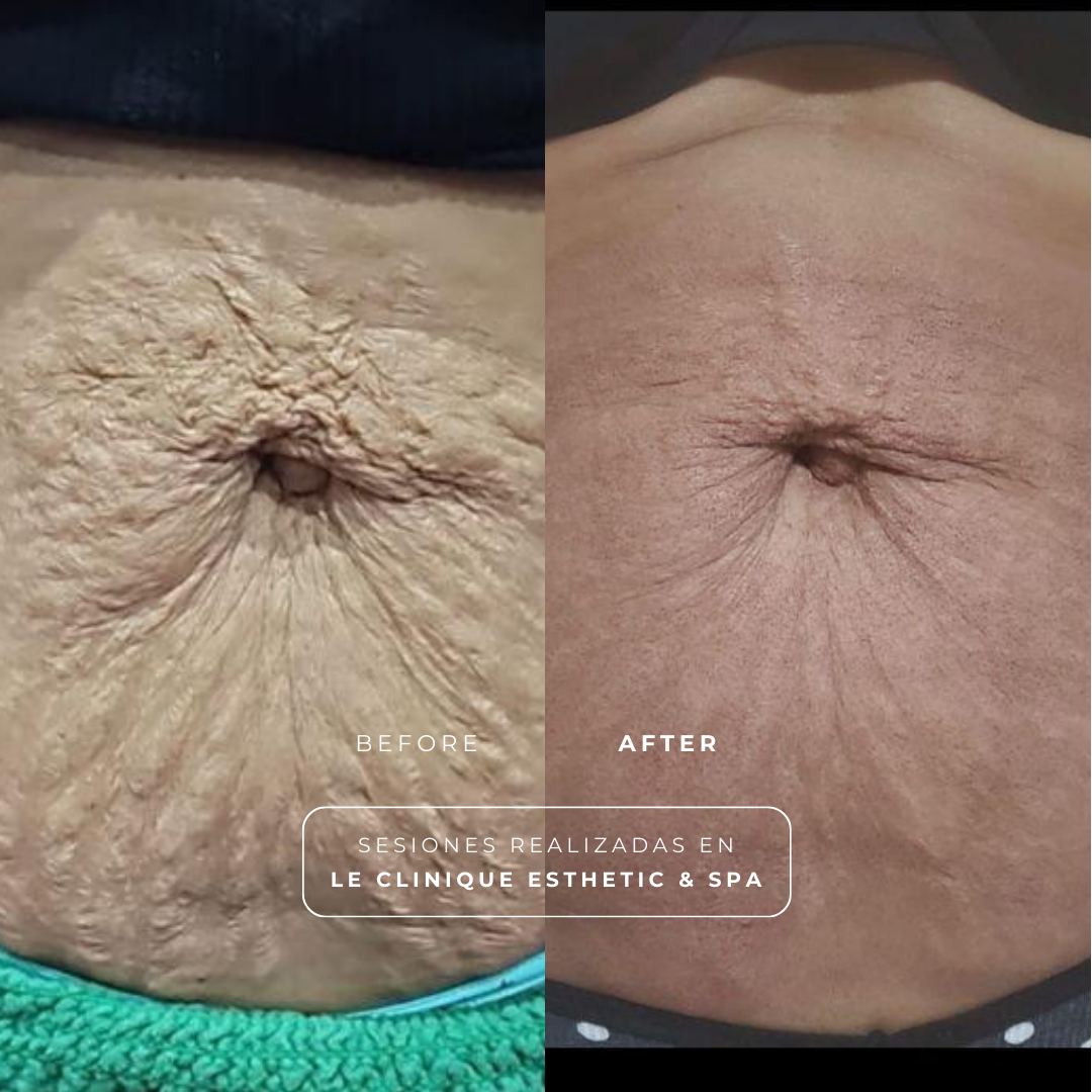 SkinTyte + MOXI (Abdomen)