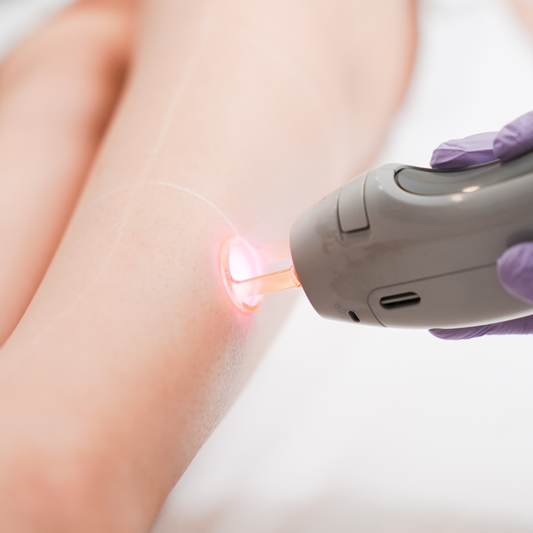 2 sesiones Láser Media Pierna