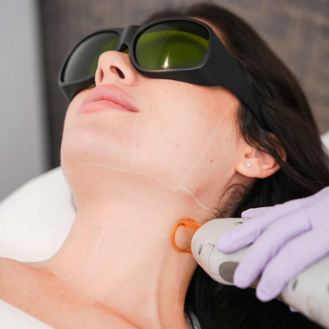 5 sesiones de Láser Cuello