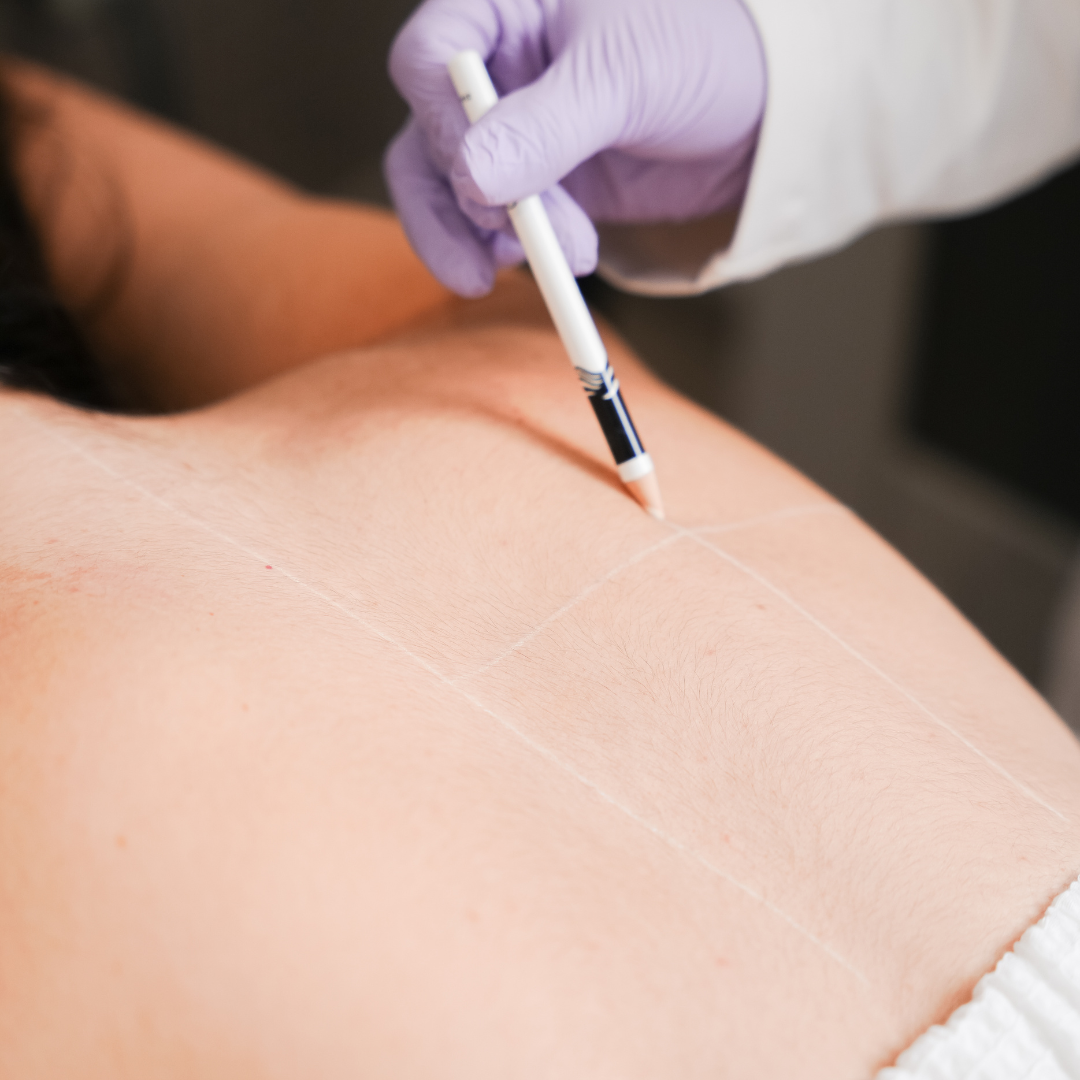 5 sesiones de Láser Espalda Completa