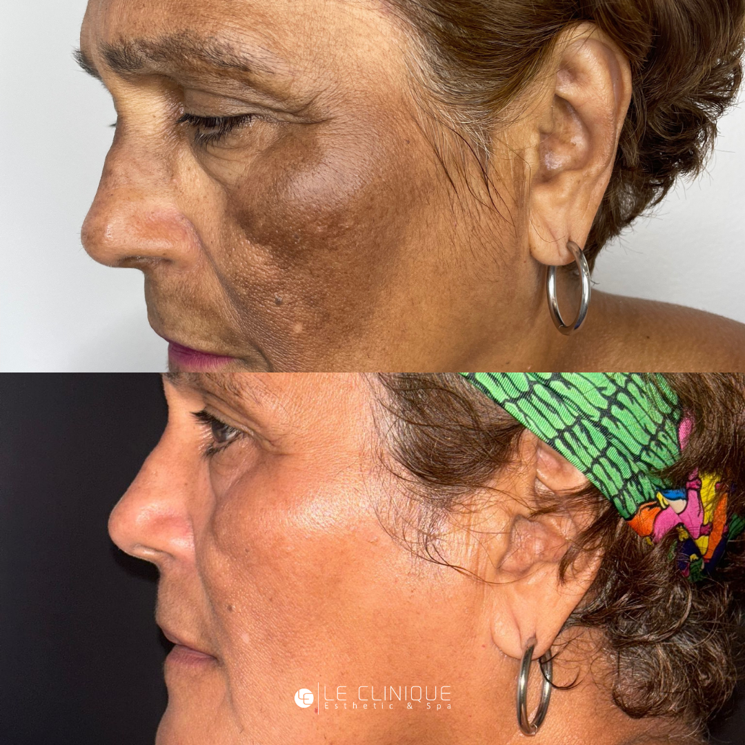 Kit Melasma