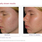 Acne Treatment System