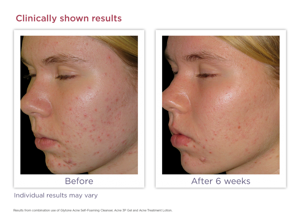 Acne Treatment System